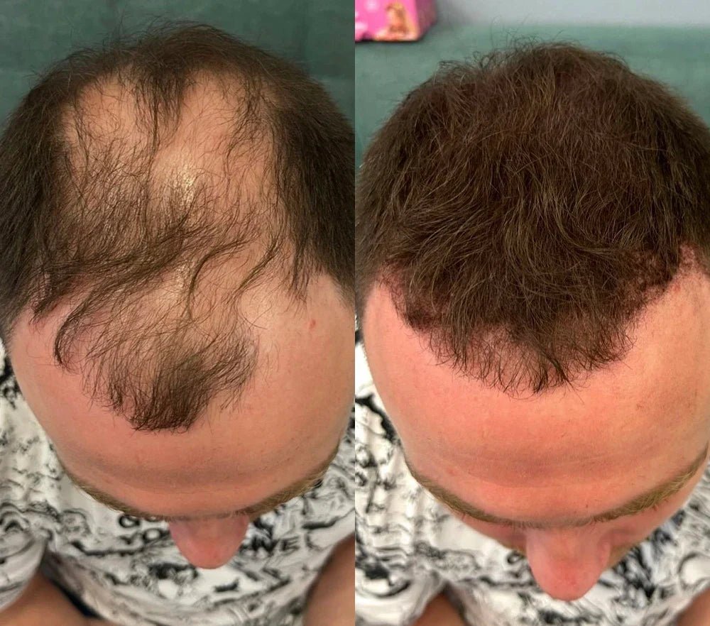 Camuflagem Capilar Profissional FixHair - Direct Ofertas