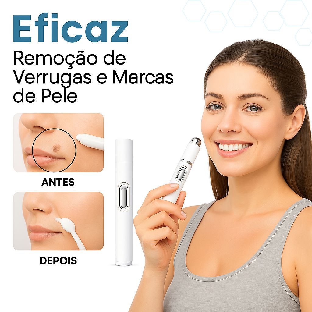 Caneta Laser MediSkin™ – Remove Manchas, Verrugas e Sinais Sem Dor - Direct Ofertas