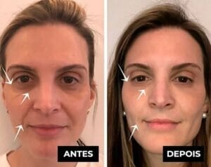 LuteinaRoll 5 em 1 ORIGINAL - Remove Olheiras, Reduz Bolsas e Revitaliza a Pele ao Redor dos Olhos - Direct Ofertas