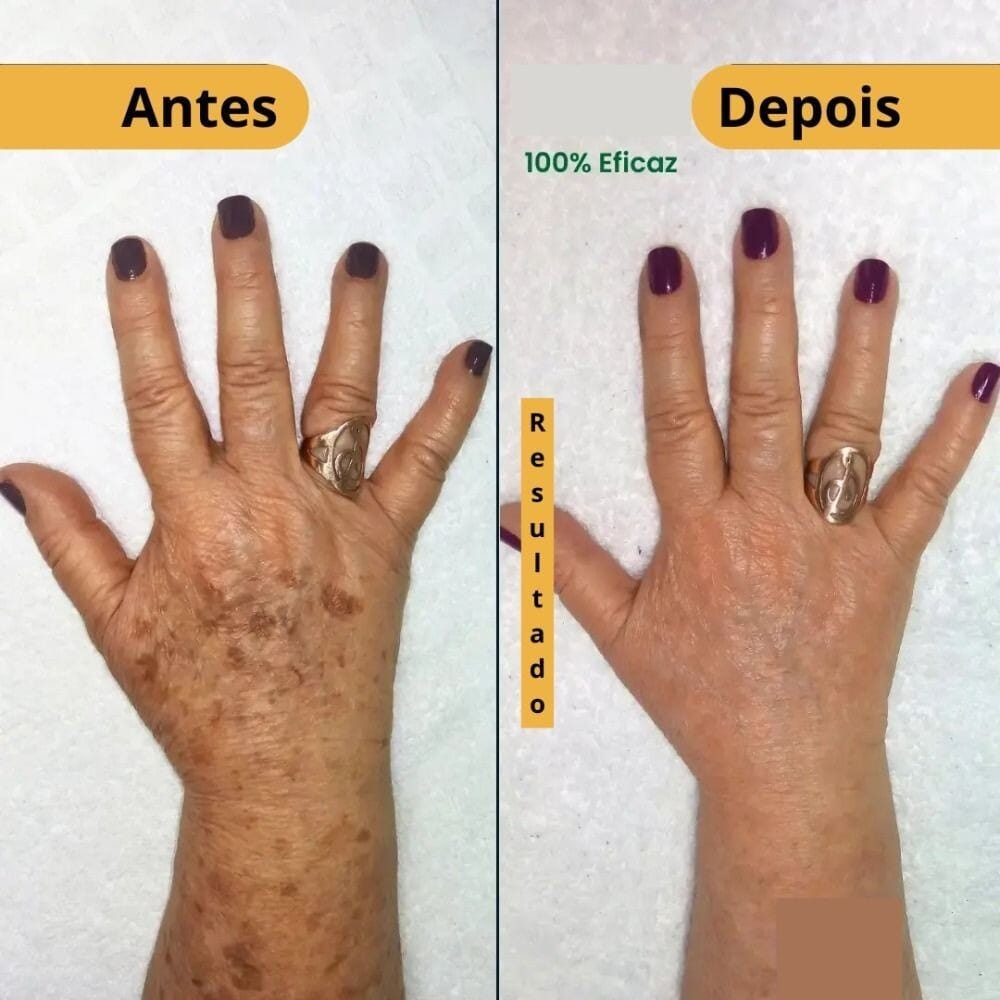 Revitta 577 Spray - Remove manchas de SOL, IDADE E MELASMA! - Direct Ofertas