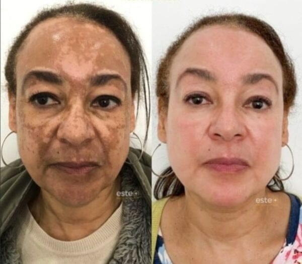 Revitta 577 Spray - Remove manchas de SOL, IDADE E MELASMA! - Direct Ofertas