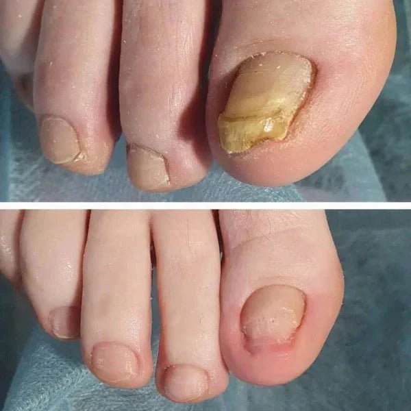 Unha Livre PRO – Solução Avançada para Unhas Saudáveis - Direct Ofertas