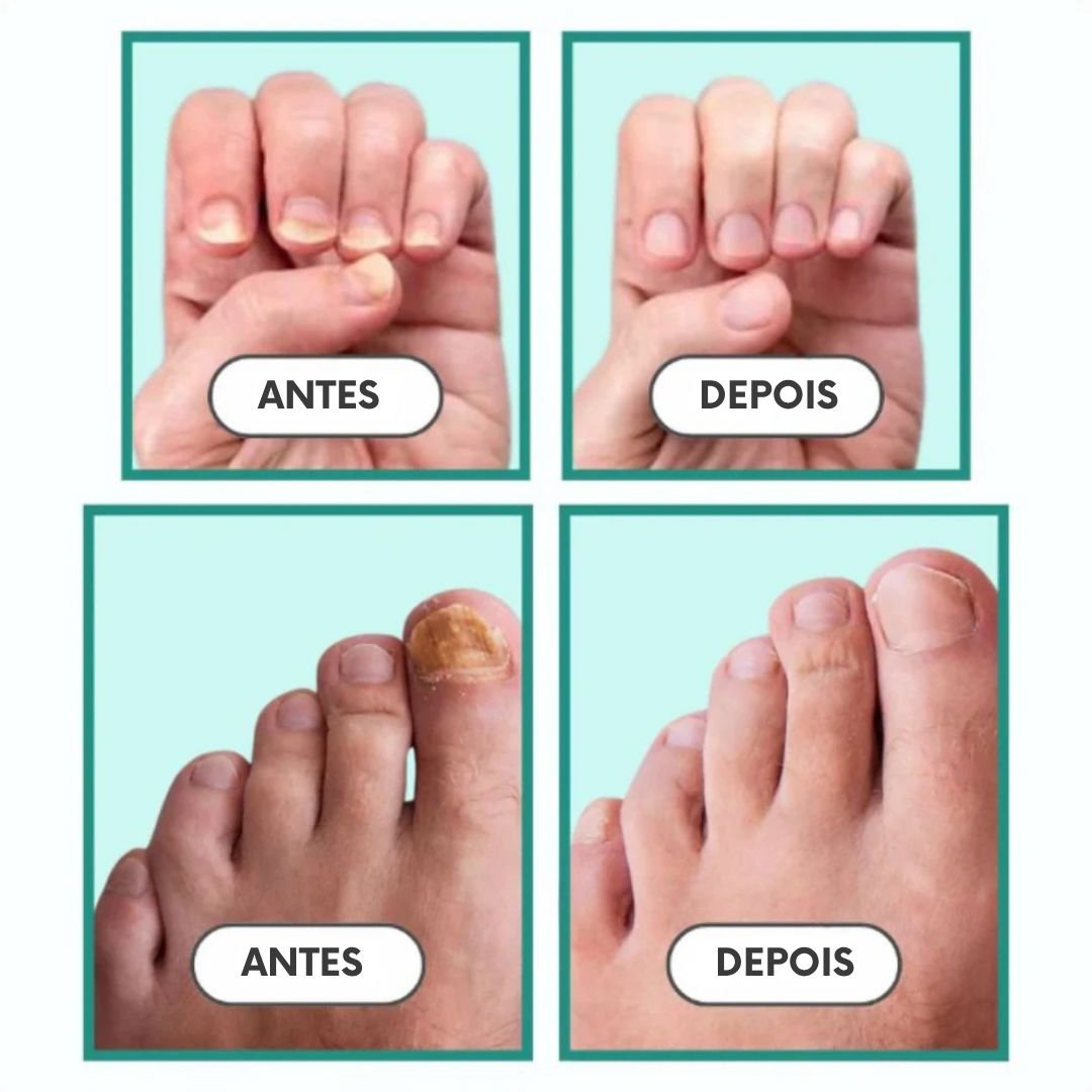Unha Livre PRO – Solução Avançada para Unhas Saudáveis - Direct Ofertas