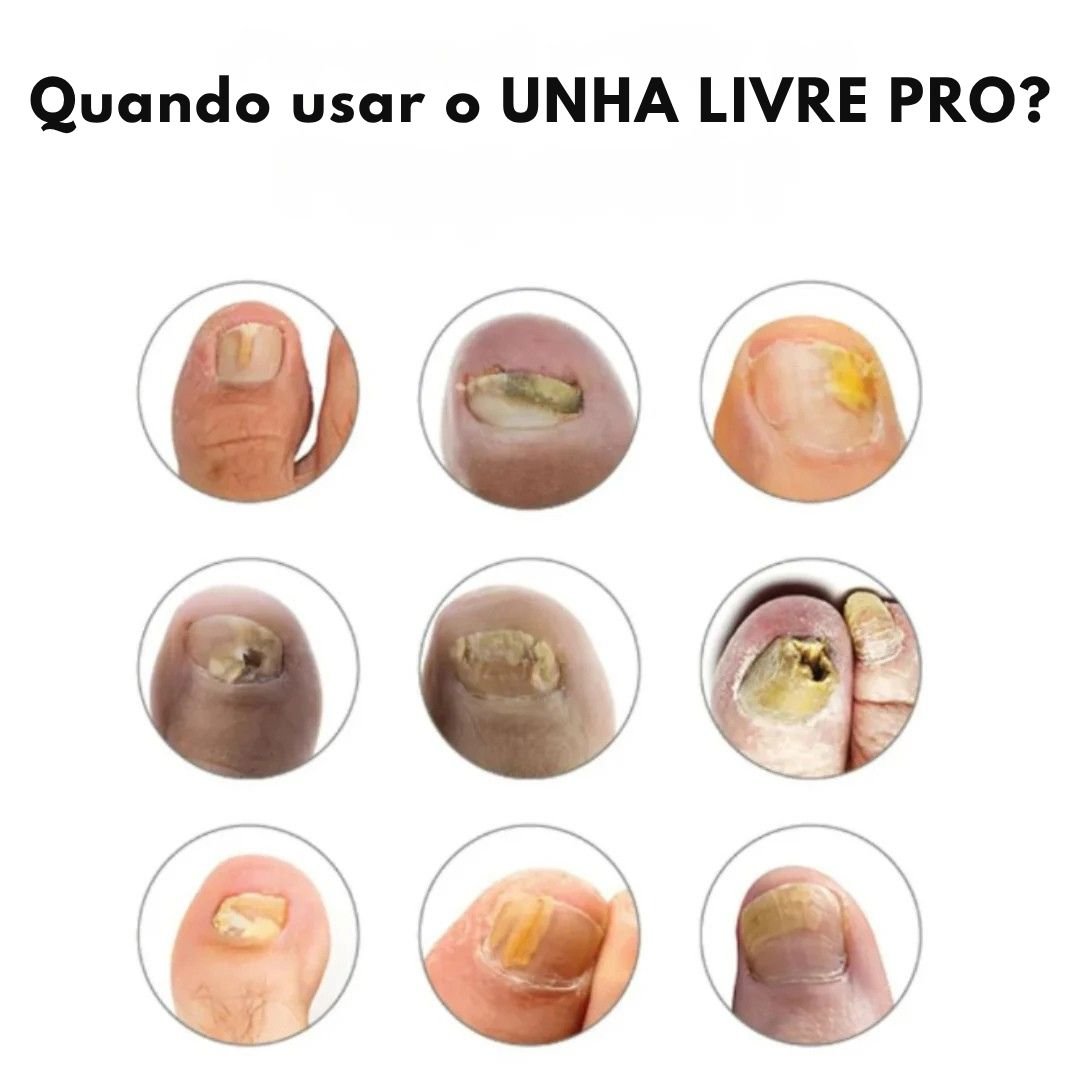 Unha Livre PRO – Solução Avançada para Unhas Saudáveis - Direct Ofertas